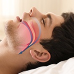 Man sleeping with arrows oon airway